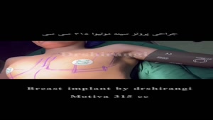جراحی پروتز سینه (افزایش حجم سینه با عمل) | دکتر سعید شیرنگی