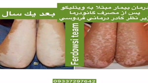 درمان بیماری پیسی در ایران 