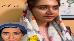 ویدیو نتیجه عمل بینی گوشتی توسط دکتر سعید شیرنگی