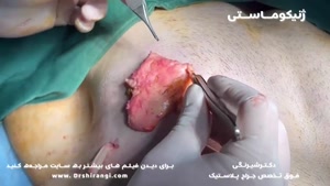 فیلم جراحی ژنیکوماستی - جراحی زیبایی سینه در مردان