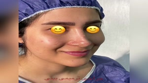 جراحی ترمیمی بینی ( عمل بینی ثانویه) توسط دکتر سعید شیرنگی