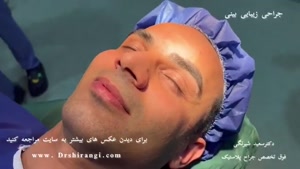 بهترین جراح بینی مردانه در تهران | دکتر سعید شیرنگی
