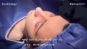 مراحل جراحی زیبایی بینی توسط دکتر سعید شیرنگی