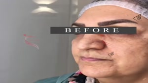 جراحی ترکیبی | لیفت صورت و گردن، بلفاروپلاستی و لیفت شقیقه