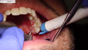 آموزش دستیار دندانپزشک -چگونگی پر کردن دندان