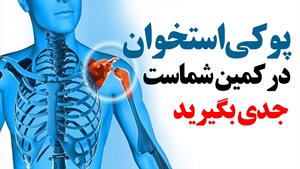 همه چیز درمورد پوکی استخوان