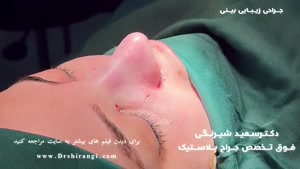 فیلم قبل و بعد از عمل زیبایی بینی دکتر سعید شیرنگی