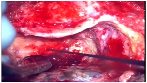 جراحی آکوستیک نوروما یا شوانوم وستیبولار با اپروچ ترانس لابی