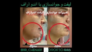 لیفتینگ و جوانسازی پوست با دستگاه پزشکی Endo-RF Subcision