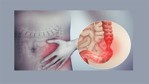 سندرم روده تحریک پذیر یا IBS چیست؟ 