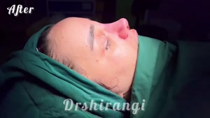 بهترین روش عمل زیبایی بینی در کلینیک دکتر سعید شیرنگی