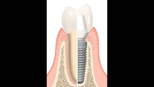 متخصص کاشت دندان (ایملنت)