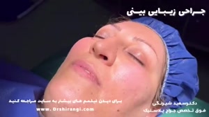 بهترین دکتر عمل بینی گوشتی در تهران