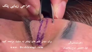فیلم کامل جراحی پلک در مطب دکتر سعید شیرنگی