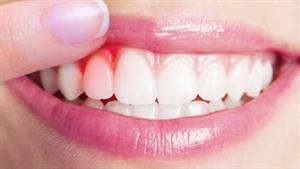 درمان خانگی دندان درد و آبسه دندان