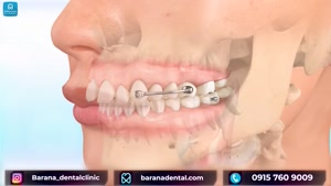 چگونه ارتودنسی باعث جابجایی دندان ها می شود؟ 