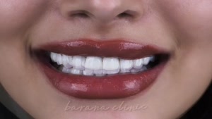 نمونه لمینت انجام شده در کلینیک دندانپزشکی بارانا