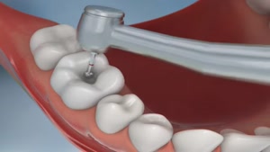 چگونه دندان را با مواد کامپوزیت پر می کنند؟ 