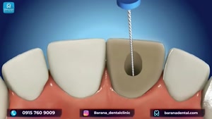 چگونه دندان جلو را عصب کشی می کنند؟