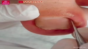 جراحی ناخن پای مردان