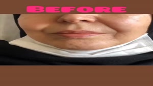 خدمات پاکسازی پوست بروجرد برداشتن خال گوشتی