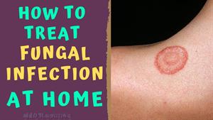 چگونه می توان عفونت قارچی پوست را در خانه درمان کرد