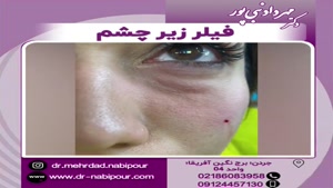 فیلر زیر چشم - رفع گودی و تیرگی