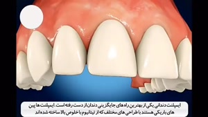 نکات مهم ایمپلنت دندان ( کلینیک دندانپزشکی شبانه روزی آرتین)