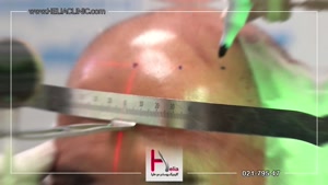 کاشت مو به روش میکروگرافت فول تراکم در کلینیک هلیا
