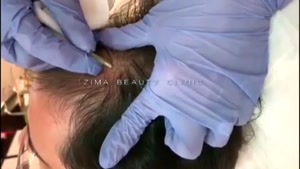 تقویت کردن موهای ظریف با دستگاه پزشکی Carboxy Therapy