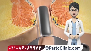 فیلم عمل جراحی شقاق مقعدی با لیزر- partoclinic.com