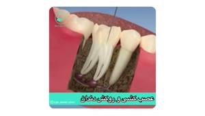 مراحل عصب کشی و روکش دندان