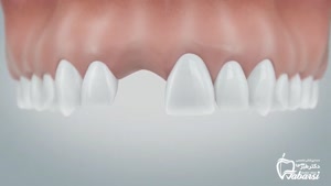 جایگزینی دندان کشیده شده: ایمپلنت یا بریج؟