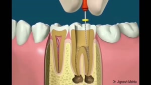عصب کشی دندان چیست چگونه انجام می شود؟