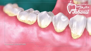 جرم گیری دندان دقیقا چیست و چرا مهم است؟