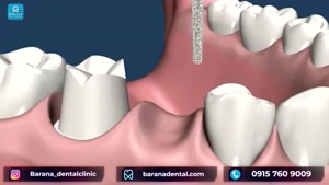 زمانی که یک دندان کشیده می شود، بریج چگونه به کمک دهان می آی