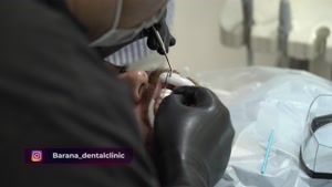 نحوه انجام لمینت دندان مراجعه کننده محترم در کلینیک دندانپزش