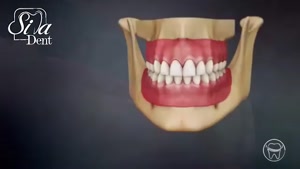 پروتز های دندانی (جایگزین دندان)