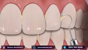 چگونه جرم گیری عمیق دندان انجام می شود؟ 