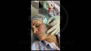 لیفتینگ و جوانسازی پوست با دستگاه پزشکی Endo-RF Subcision