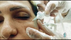 درمان سیاهی دور چشم با دستگاه پزشکی Carboxy Therapy