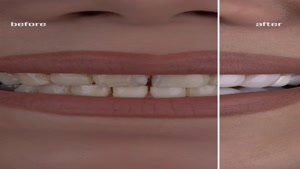 قبل و بعد از کامپوزیت دندان 