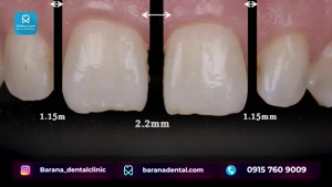 تاثیر استفاده از کامپوزیت دندان در مرتب شدن آن ها