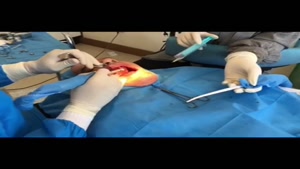 فیلم جراحی ایمپلنت در یک روز