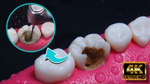 مراحل پر کردن دندان / فیلم ترمیم دندان 