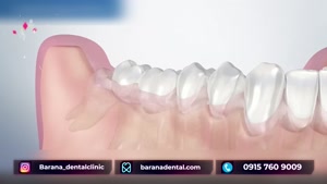 جراحی دندان عقل نهفته چگونه انجام میشود؟