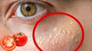 درمان دانه های زیر چشم و بستن منافذ پوست