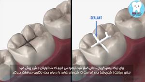 راه جلوگیری از پوسیدگی دندان