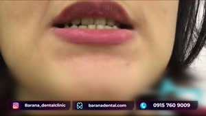 لمینت متحرک دندان در مشهد برای دو فک 