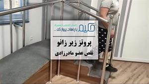 پروتز زیر زانو نقص عضو مادرزادی